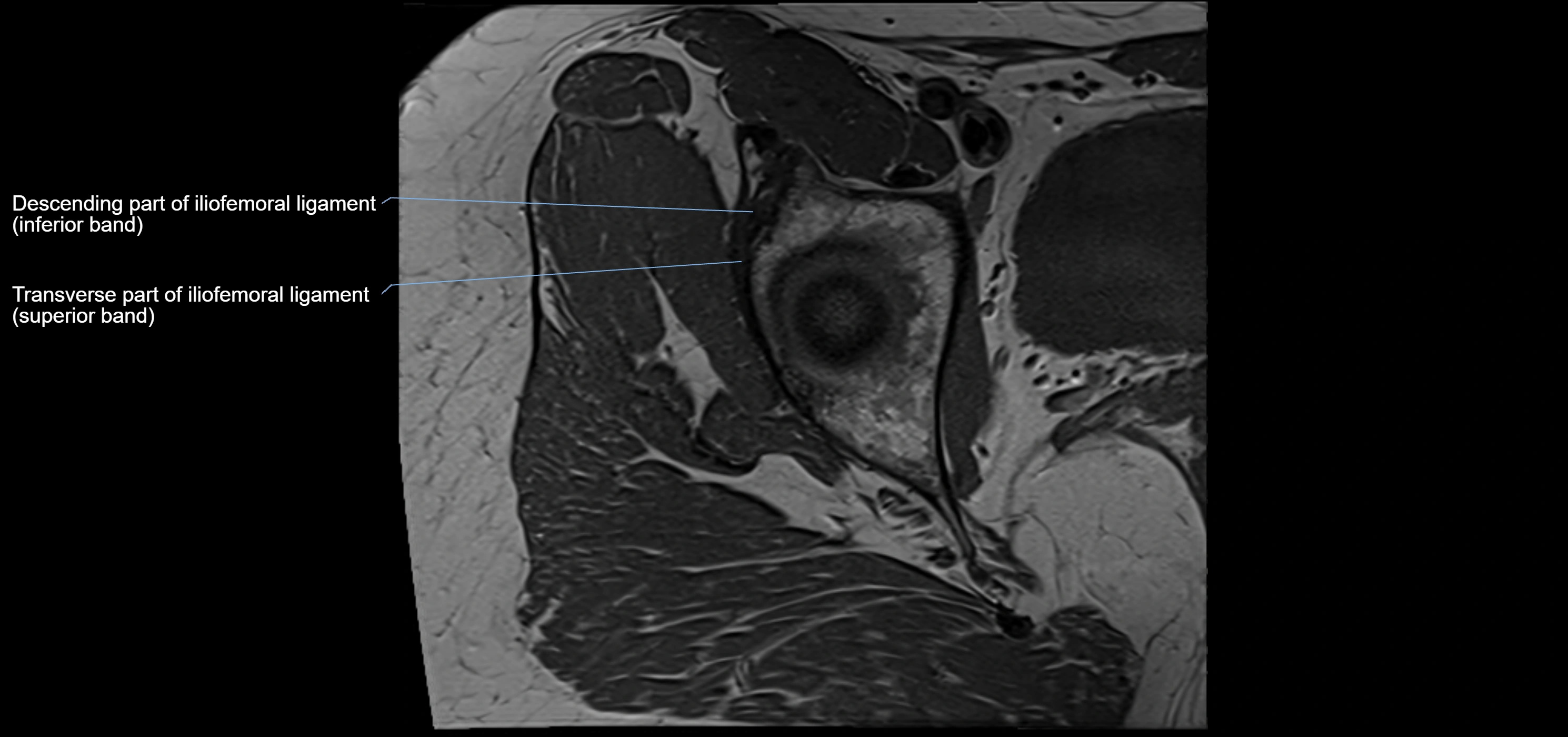 Hip ligament anatomy axial 3T MRI image -img-13001-00010.webp